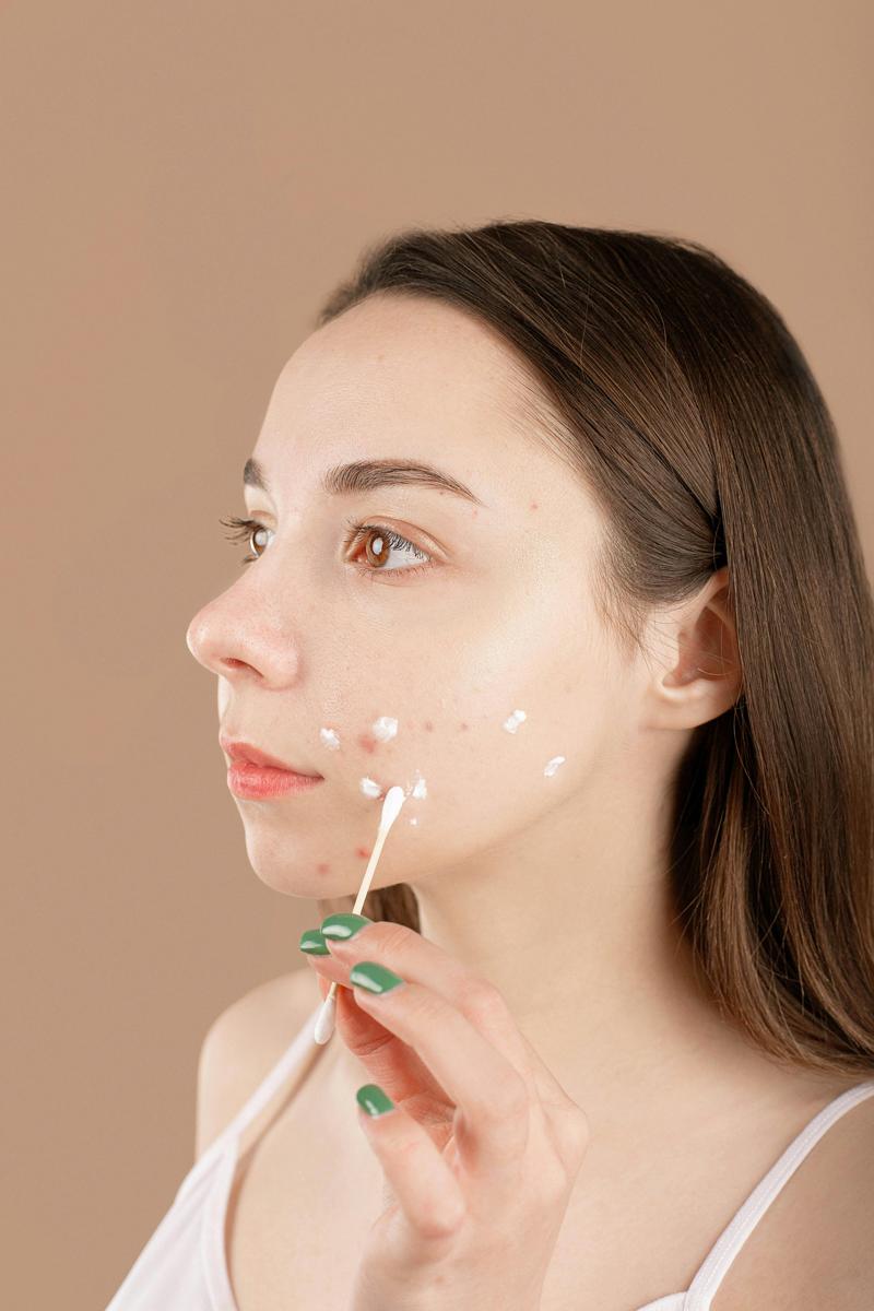 natural acne remedies