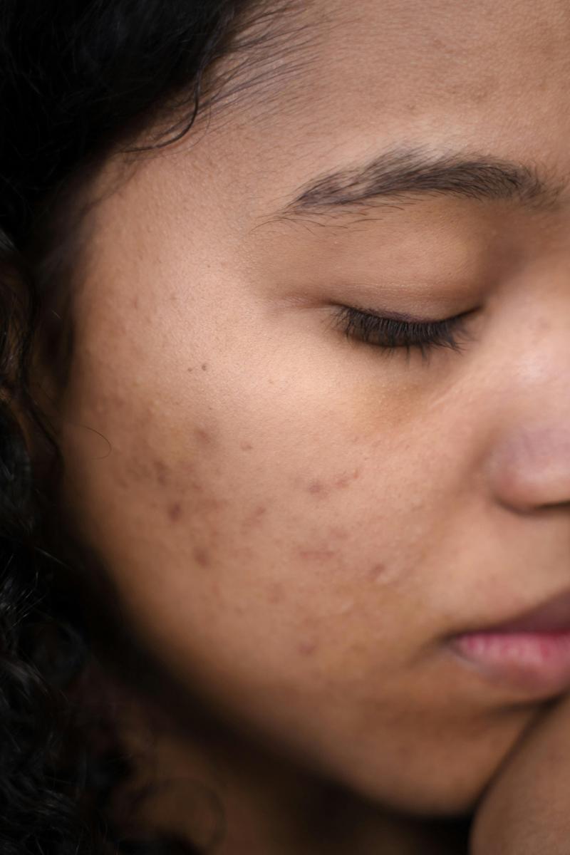 natural acne remedies